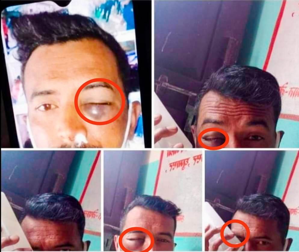 इन्स्पेक्टर नवीन चापागाईंले गुन्डागर्दी सैलीमा कुटे हवल्दारलाई गम्भीर चोट उपचारको लागि नेपालगन्ज