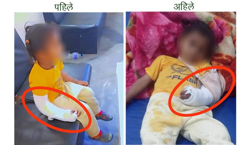 डाक्टरको लापरबाहीले देब्रे हात भाँच्चिएर आएका बालकको दाहिने हातमा प्लास्टर