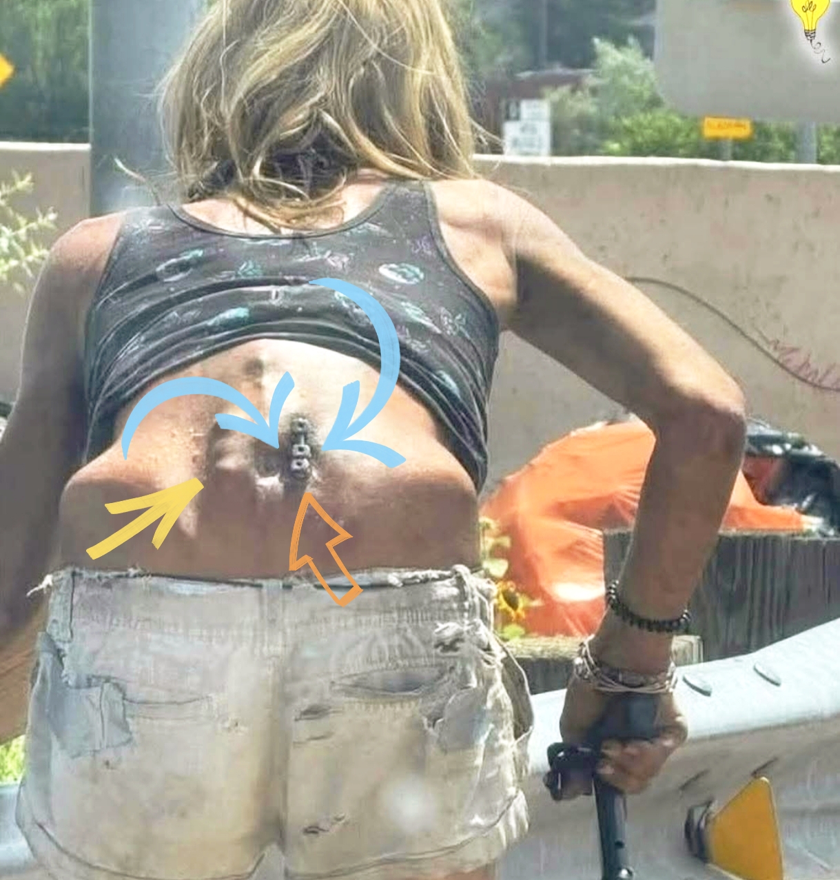 फुटपाथमा एक महिला उनको ढाडमा राखिएको शल्यक्रियाको फलाम छाला भित्रबाट बाहिर निस्किँदै,